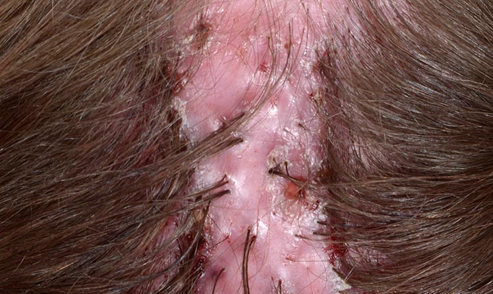 1726918815 22784 folliculitis decalvans