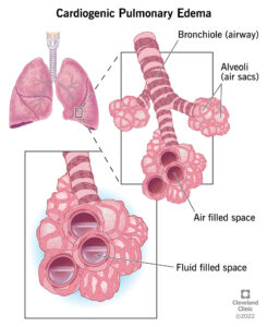 1727133314 22941 cardiogenic pulmonary edema