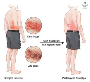 1727188221 12093 postherpetic neuralgia