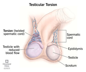 1727282416 15382 testicular torsion