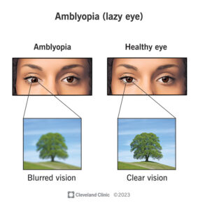 1727316617 10707 amblyopia lazy eye