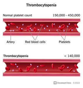 1727350516 14430 thrombocytopenia