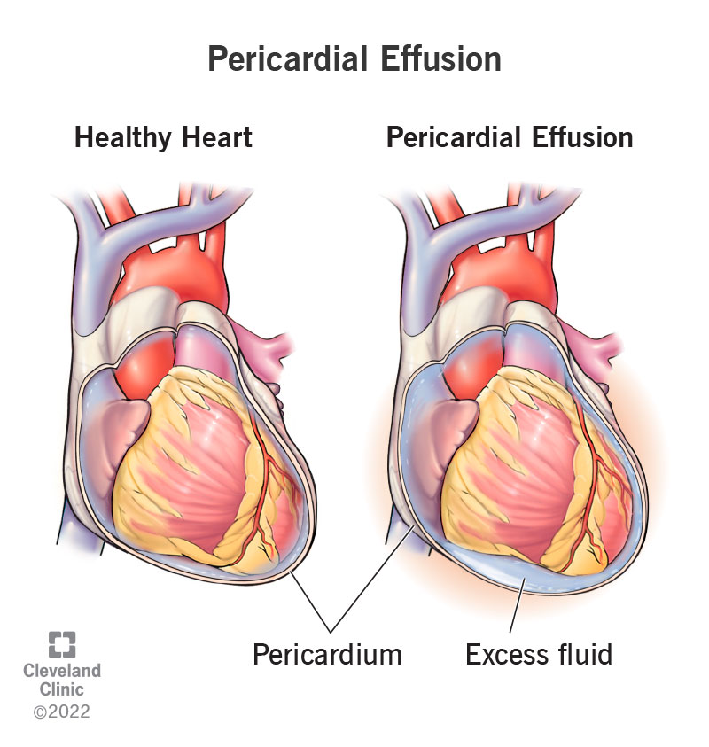 Un cuore sano e un cuore con versamento pericardico