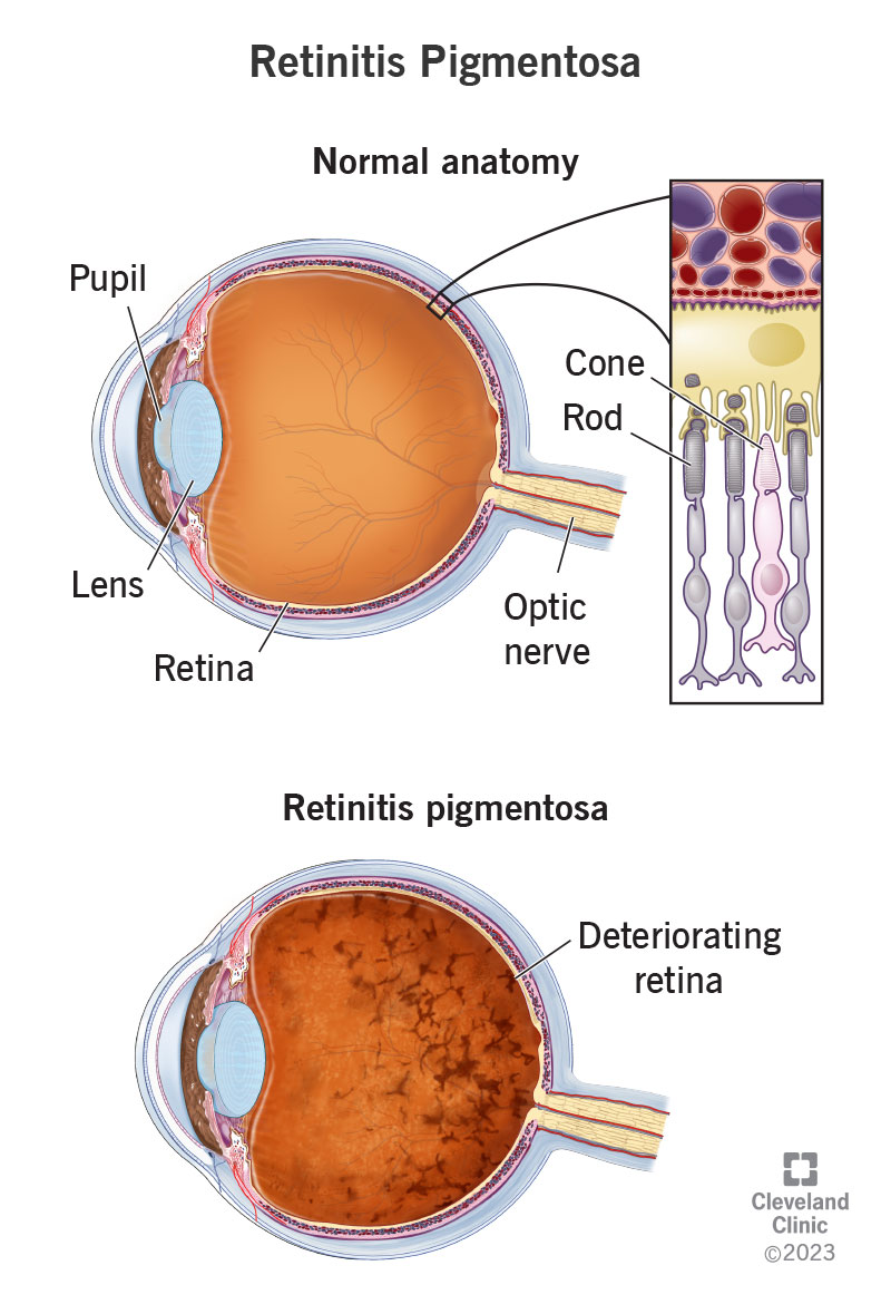 La retinite pigmentosa colpisce la retina e i suoi coni e bastoncelli; le altre parti dell'occhio sono la pupilla, il cristallino e il nervo ottico.