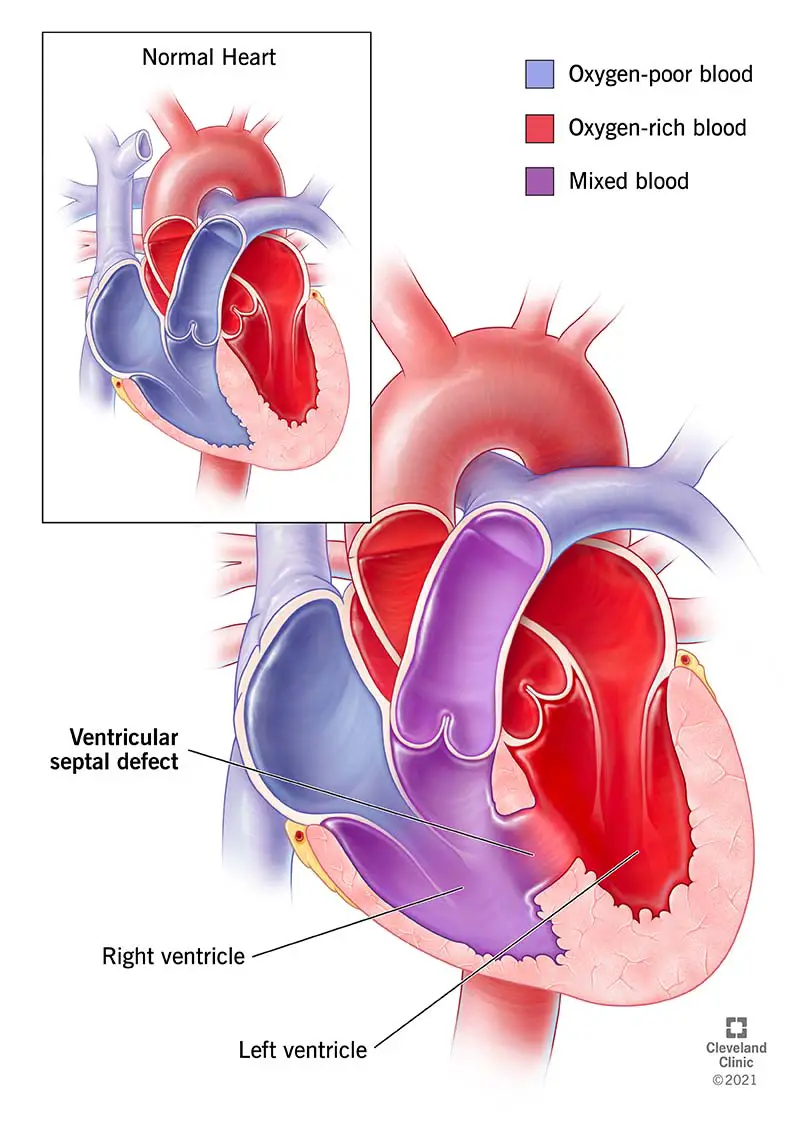 cuore con difetto del setto ventricolare (VSD)