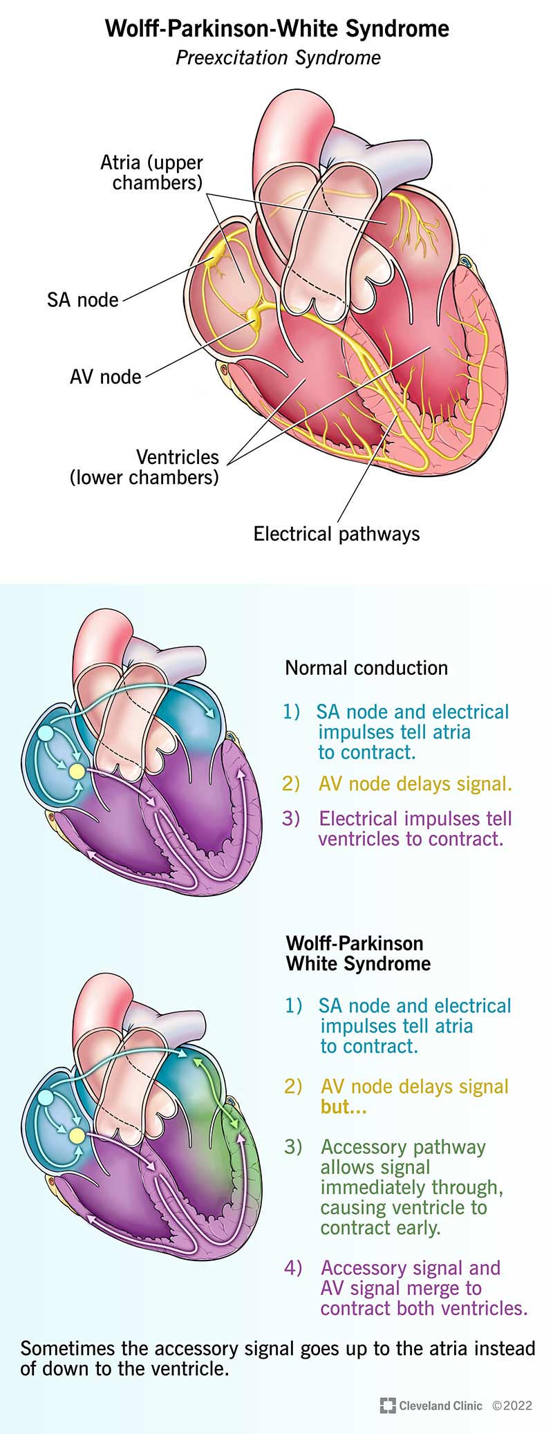 Se soffri della sindrome di Wolff-Parkinson-White, il tuo cuore batte troppo velocemente.