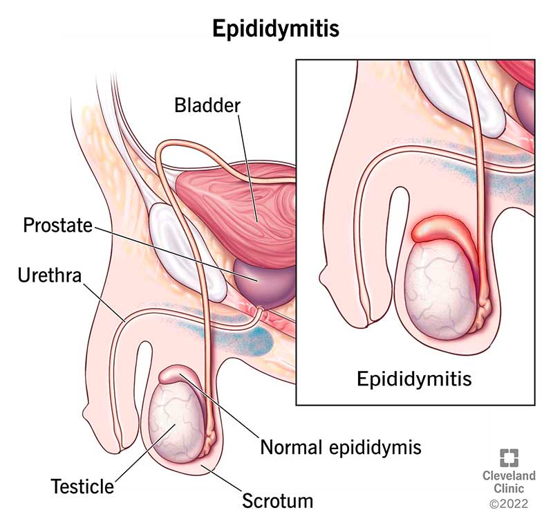 epididimo sano vs epididimite