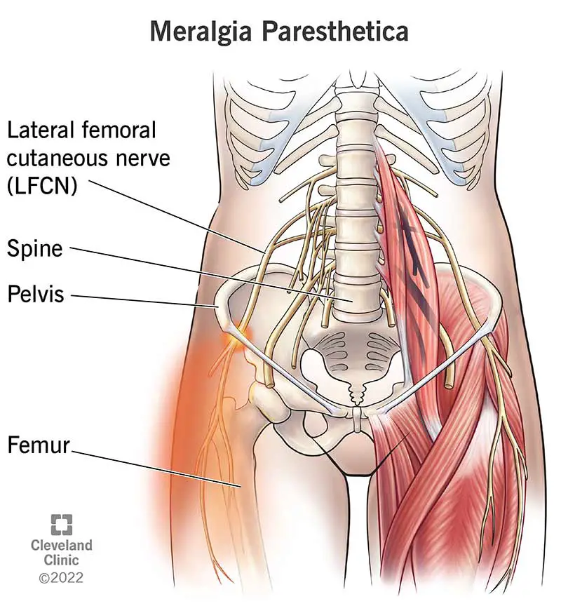 Infiammazione del nervo cutaneo femorale laterale, che inizia nella colonna vertebrale e si estende lungo il bacino e la coscia.