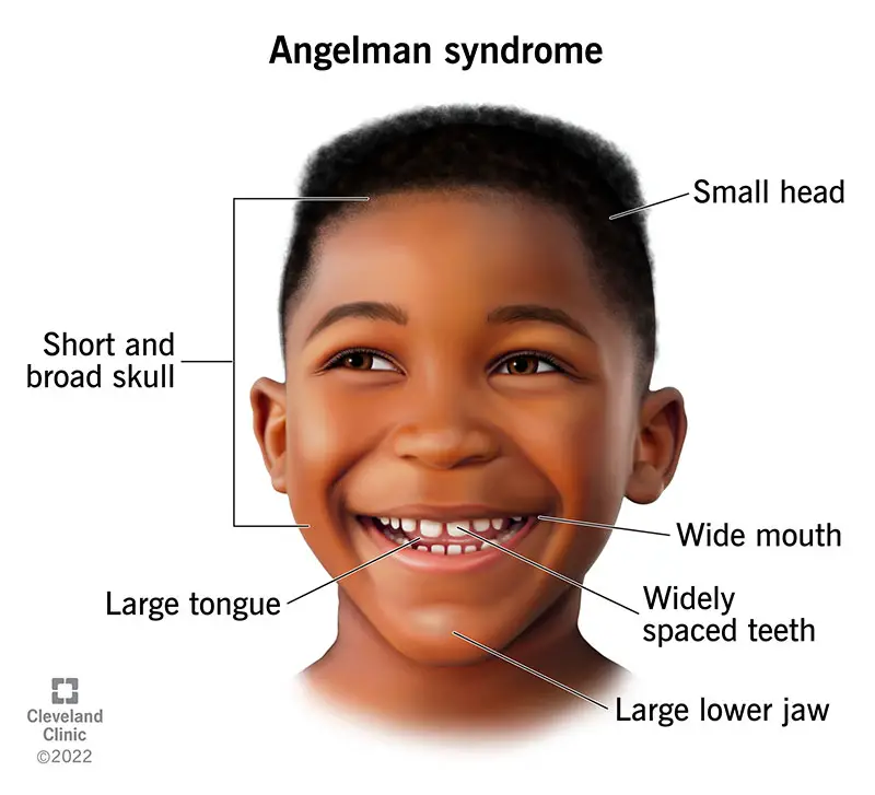 Caratteristiche facciali distintive, tra cui un cranio corto e largo, denti ampiamente distanziati e una lingua anormalmente grande.