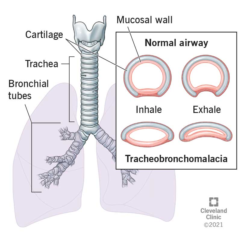 Diagramma della trachea e dei bronchi a sinistra. A destra, dettaglio su come la tracheomalacia restringe la trachea e chiude le vie aeree