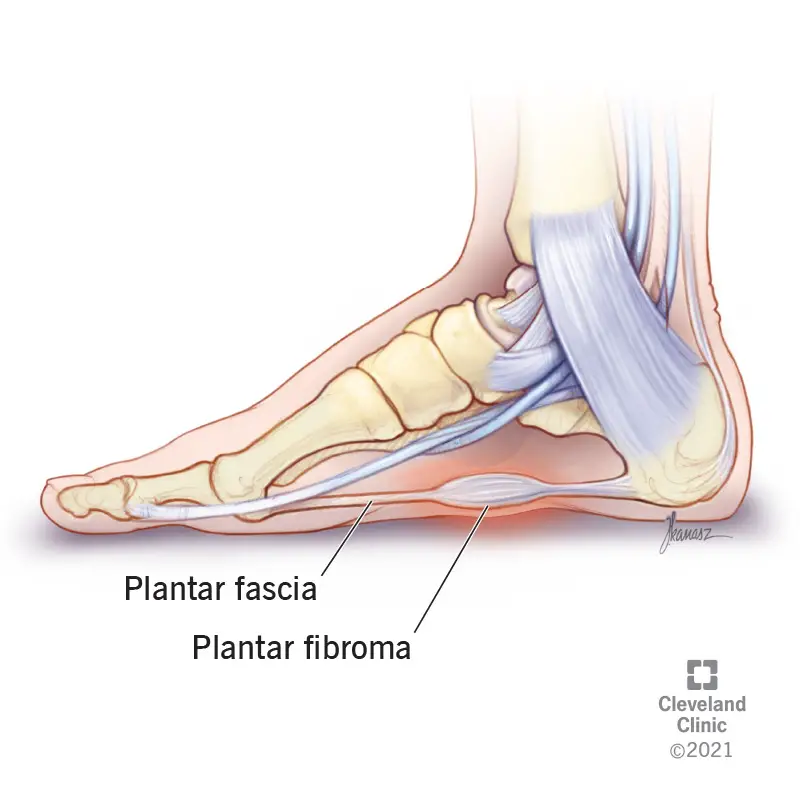 Fibroma plantare che cresce sull'arco plantare.