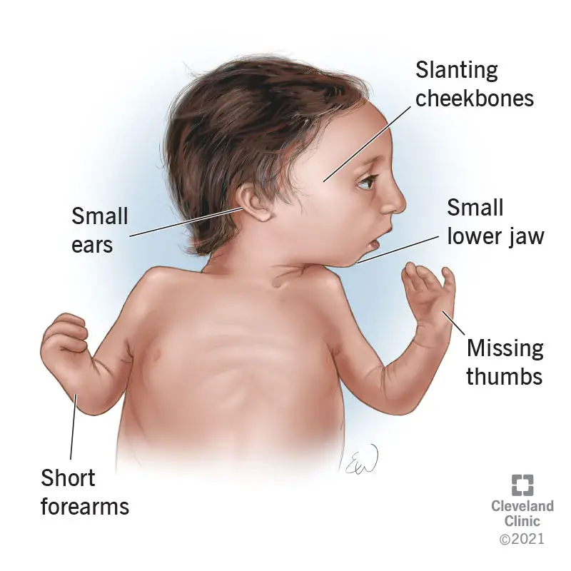 Alcuni dei sintomi della sindrome di Nagar in un neonato.