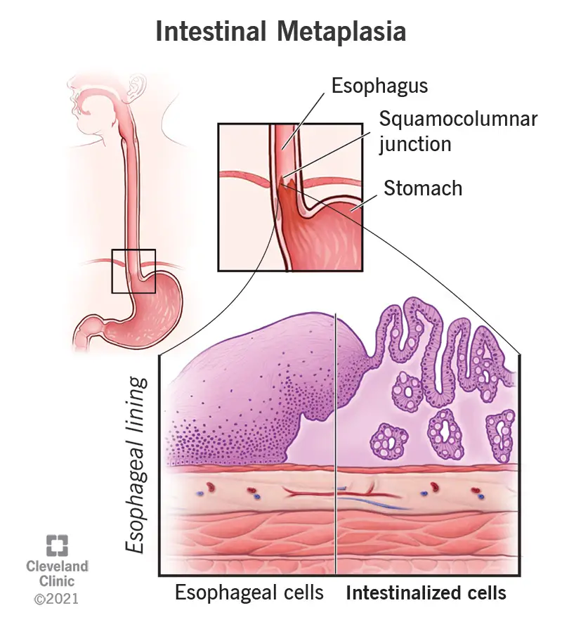 La metaplasia intestinale si verifica quando le cellule che rivestono lo stomaco o l'esofago vengono sostituite da cellule potenzialmente precancerose.