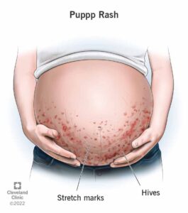 22374 puppp rash