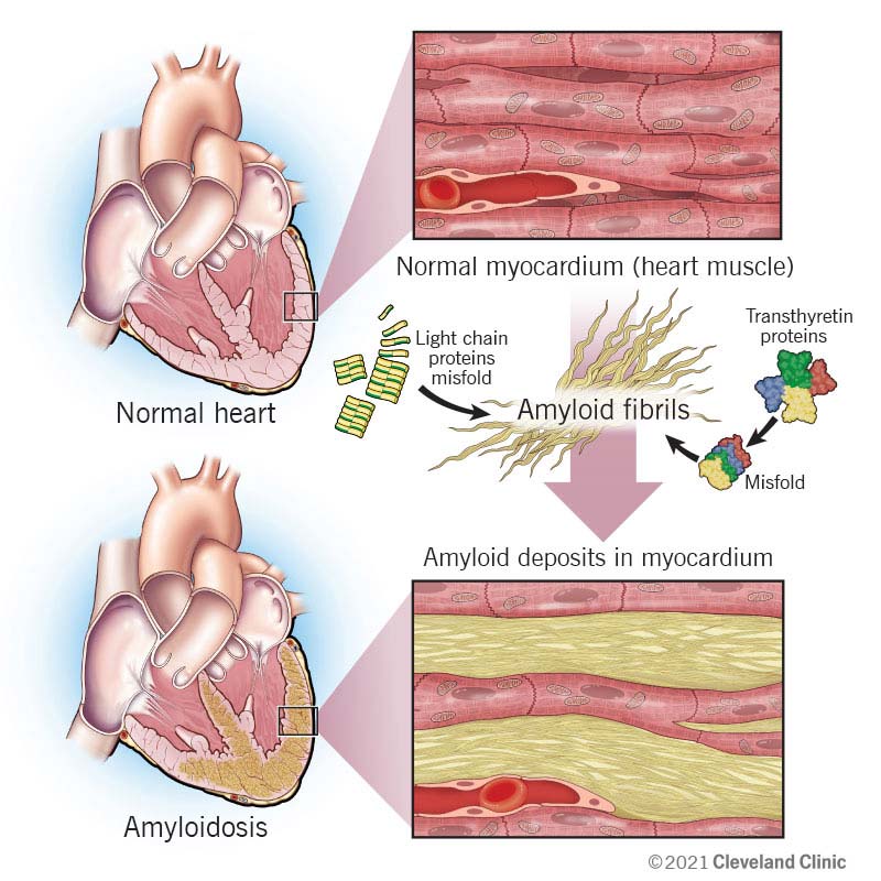 Come le fibrille proteiche amiloidi si accumulano e interrompono la funzionalità del muscolo cardiaco.