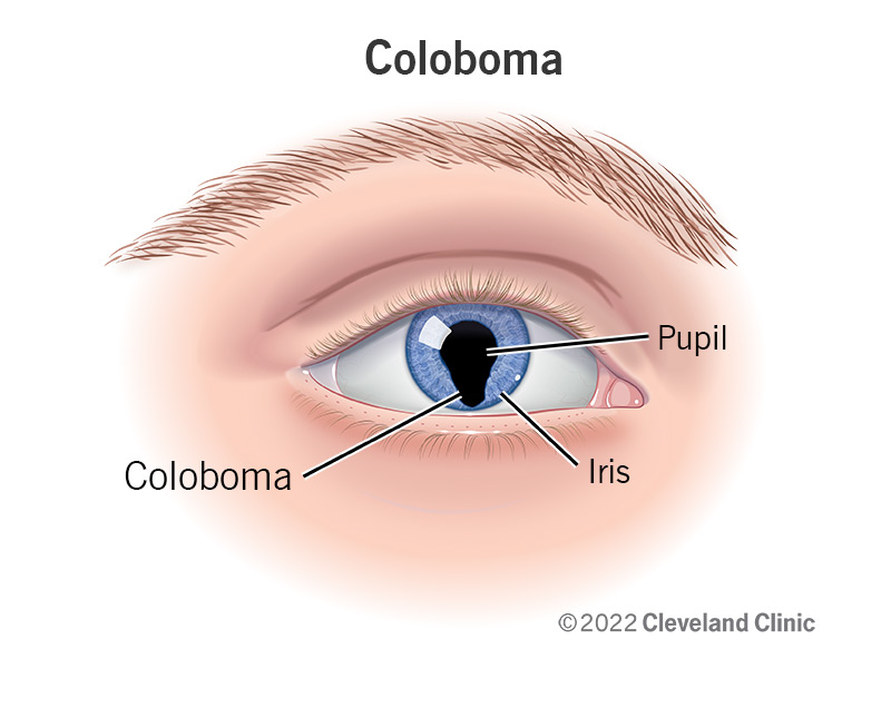 Un coloboma nell'iride di un occhio.