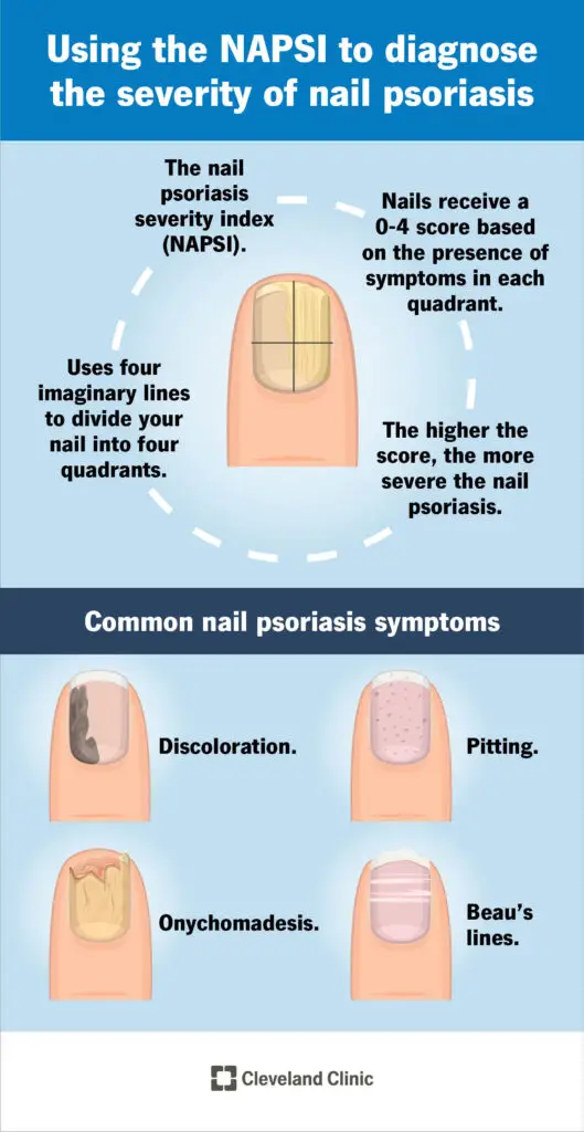 22841 nail psoriasis