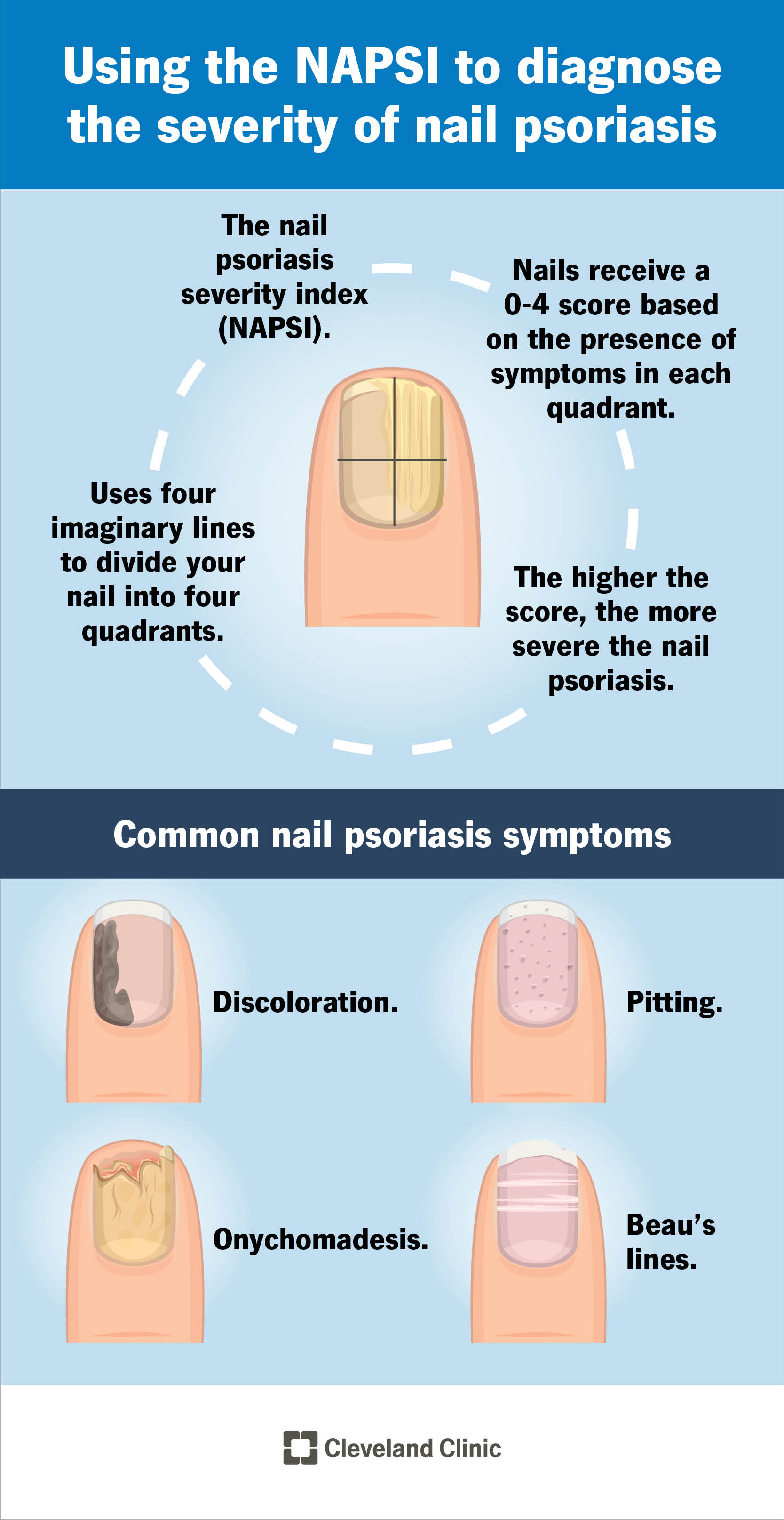 Infografica che spiega come l'indice NAPSI viene utilizzato per diagnosticare la gravità della psoriasi ungueale.