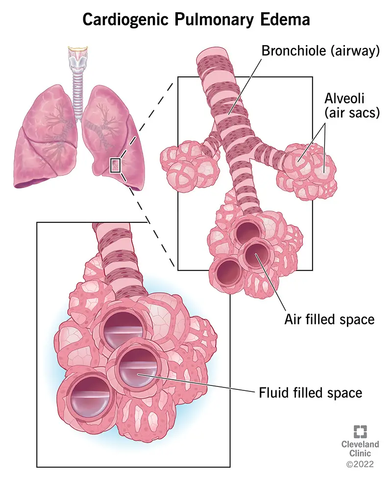 Illustrazione dell'edema polmonare cardiogeno, un accumulo di liquido in eccesso nei polmoni.