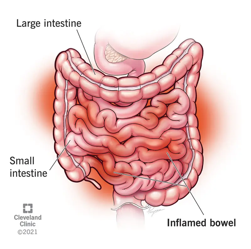 L'enterite è un'infiammazione dell'intestino tenue.