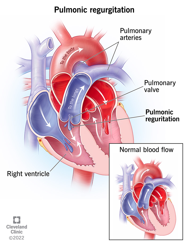 Il rigurgito polmonare si verifica quando il sangue refluisce attraverso la valvola polmonare, esercitando una pressione eccessiva sul cuore.