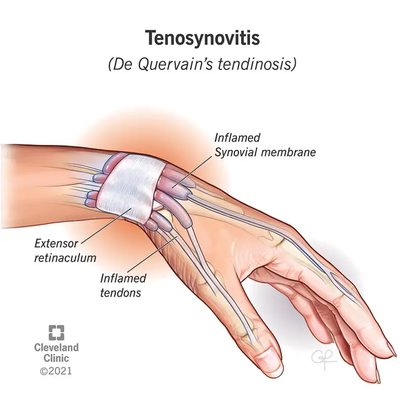 Illustrazione di un polso sinistro con tendinosi di De Quervain, una forma di tenosinovite