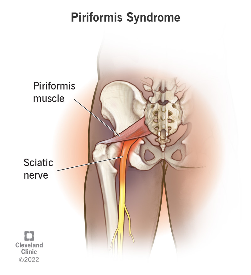 Sindrome del piriforme evidenziata in una gamba.