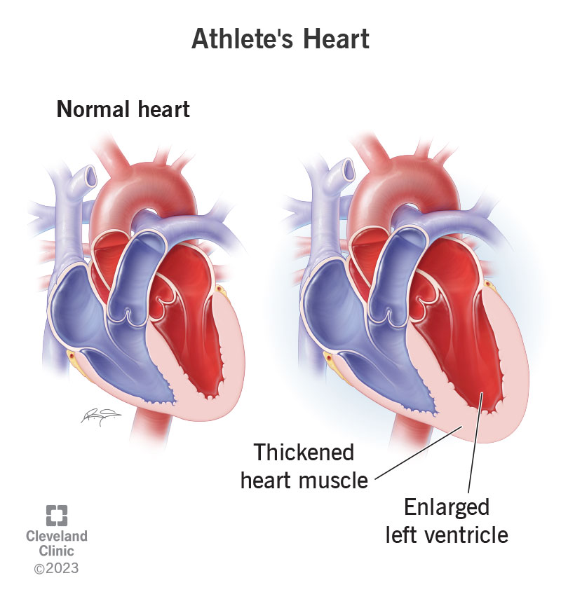 Il cuore d'atleta aumenta le dimensioni e lo spessore della parete del ventricolo sinistro dell'atleta.