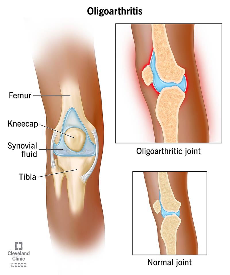 L'oligoartrite causa dolore e gonfiore alle articolazioni grandi del corpo. Fa sì che le articolazioni siano rigide e sembrino più grandi del normale.