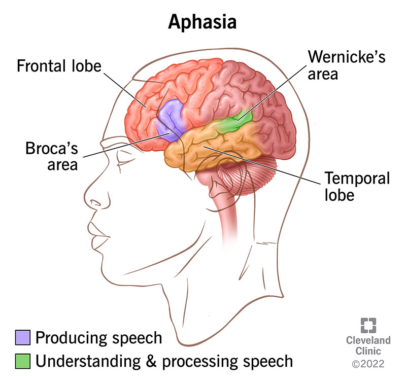 L'afasia colpisce le aree del cervello che controllano la capacità di parlare, le parole che usiamo o il modo in cui le comprendiamo.