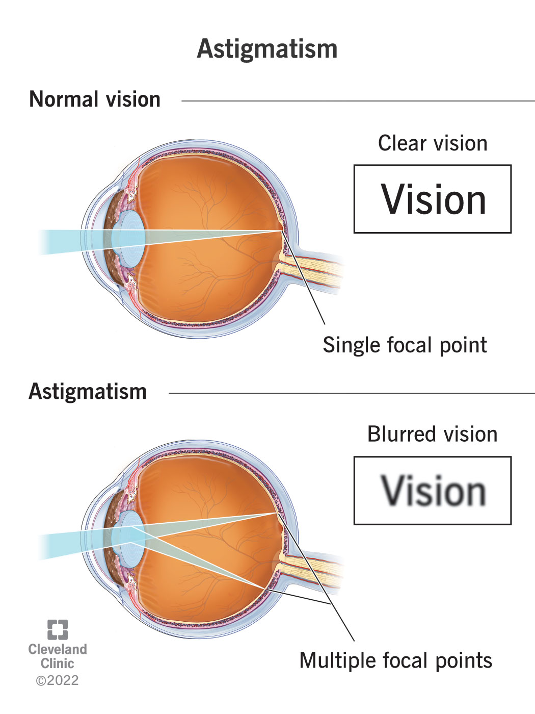 Un'illustrazione che mostra come l'astigmatismo provoca una visione offuscata