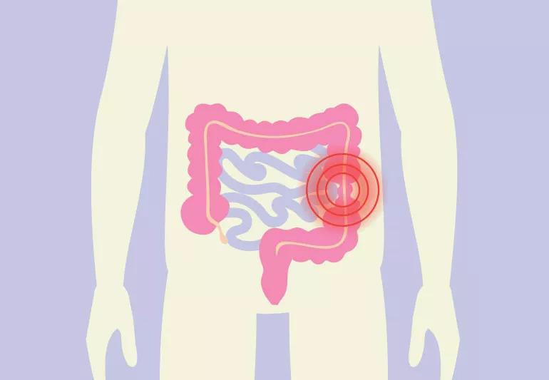 Sintomi della sindrome dell'intestino irritabile