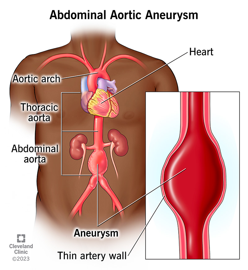 L'illustrazione mostra un ingrossamento o rigonfiamento nell'aorta addominale. Questo rigonfiamento è un aneurisma aortico addominale.