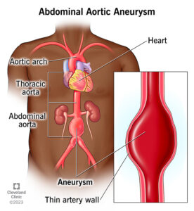 abdominal aortic aneurysm