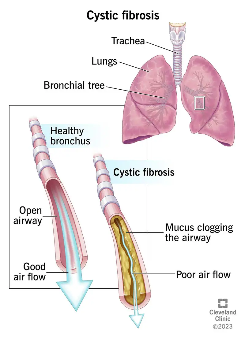 Immagine di un bronco sano nei polmoni e di uno con fibrosi cistica. Il muco denso in una persona con FC limita il flusso d'aria.