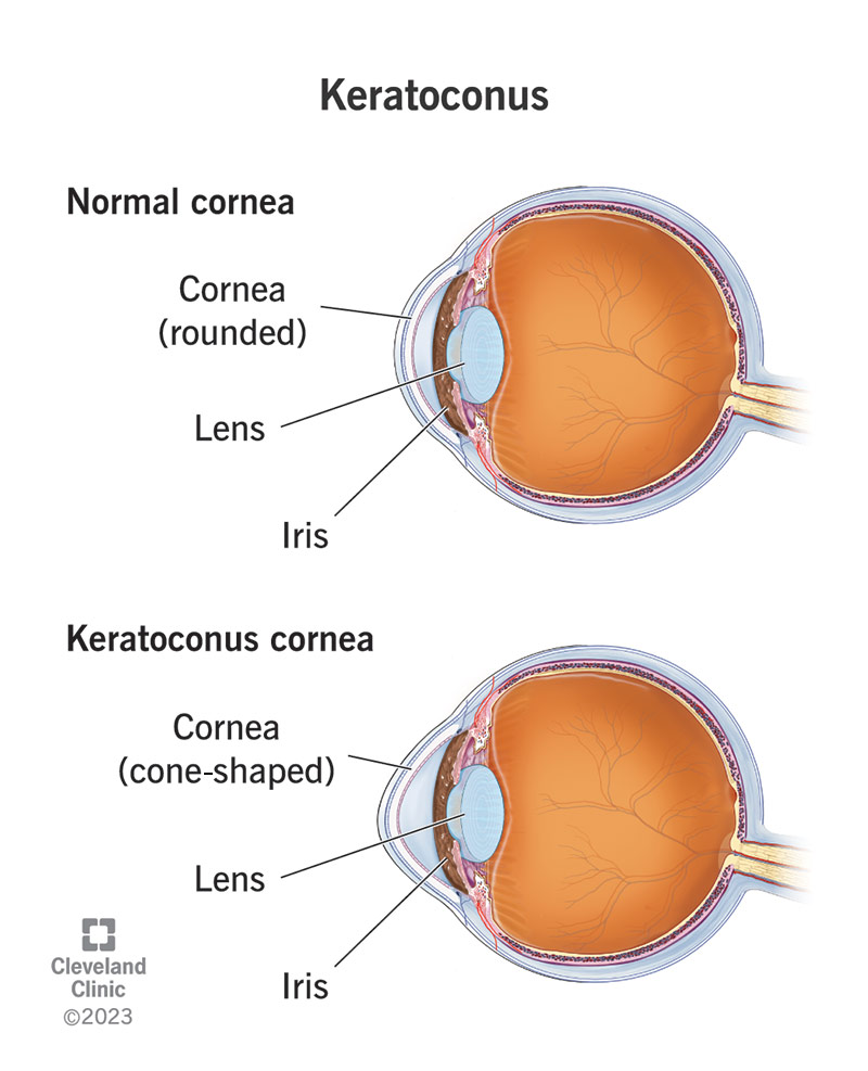 In un occhio normale, la cornea a forma di cupola protegge il cristallino e l'iride; nel cheratocono, la cornea ha la forma di un cono.