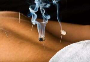 moxibustion 147320515 770x533 jpg