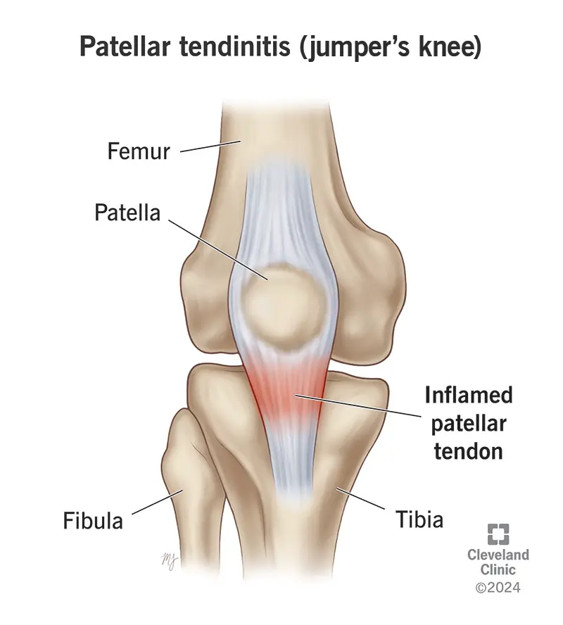 La tendinite rotulea è una dolorosa infiammazione del tendine che collega la rotula alla parte superiore della tibia.