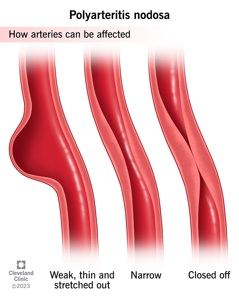 La poliarterite nodosa infiamma le arterie, rendendole strette e chiuse