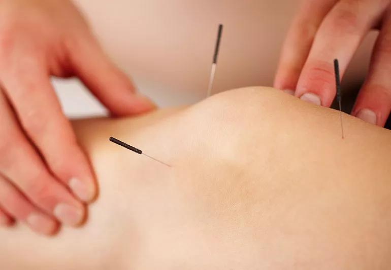 acupuncture 154894365