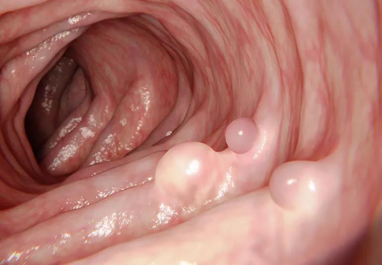 colonPolyp 648840346 770x533 1 jpg