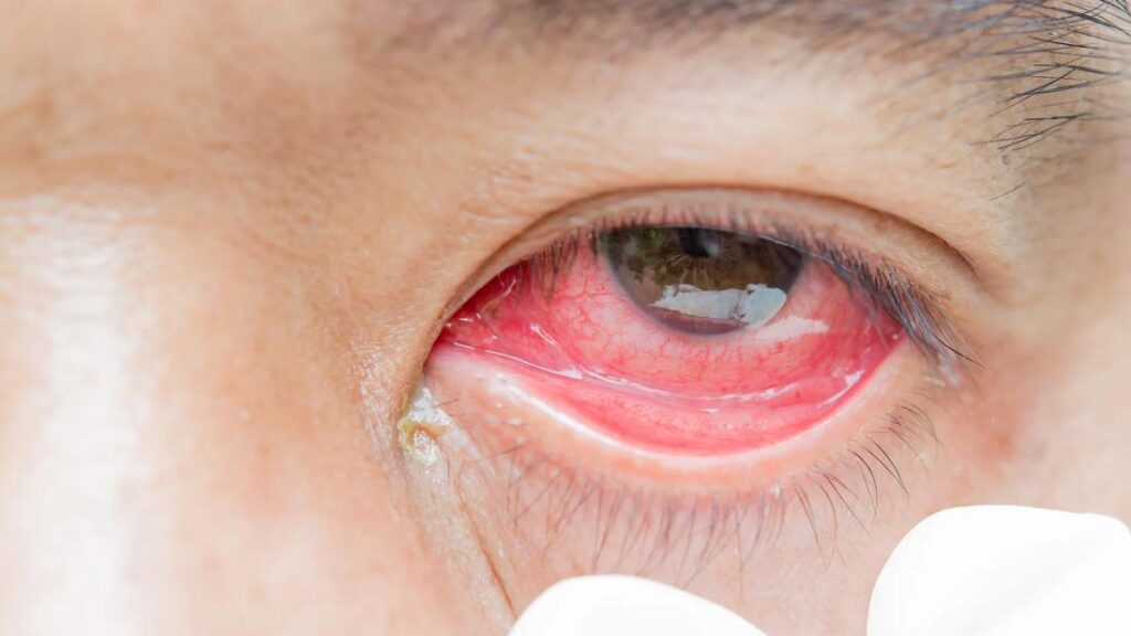 infected eye 496430796